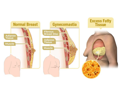 MenTherm Bee Venom Gynecomastia Heating Oil